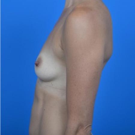 Before image 3 Case #87816 - Breast Augmentation with Natrelle Inspira Smooth Round Gel breast implants, 325cc SRF.