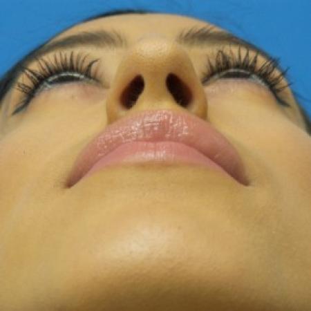 Before image 4 Case #87301 - 23-year old - Open Rhinoplasty - 3 months post-op