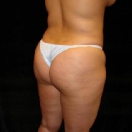 Before image 4 Case #80491 - Buttocks Augmentation Via Fat Grafting with Liposuction of Abdomen, Waist, Flanks, and Dorsal Roll