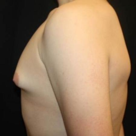 Before image 3 Case #84536 - Gynecomastia - 17 year old male