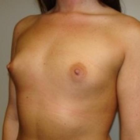 Before image 2 Case #79381 - Breast Augmentation