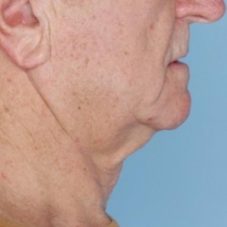 Before image 3 Case #80626 - Ulthera