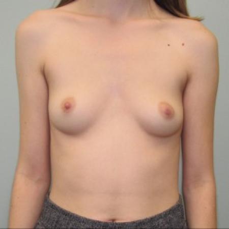 Before image 1 Case #87346 - Breast Augmentation in 22 year-old