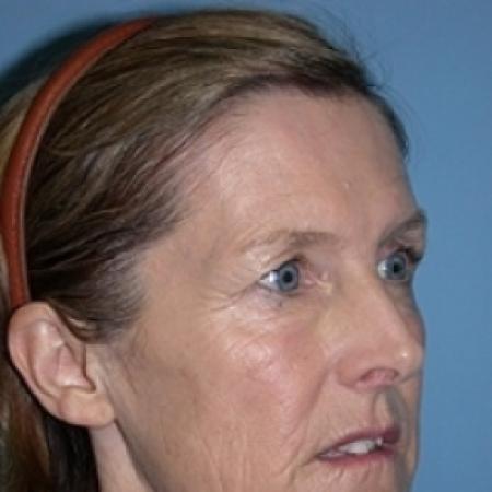 Before image 3 Case #79276 - Facelift