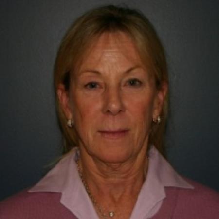 Before image 1 Case #81056 - Facelift