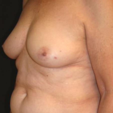 Before image 2 Case #84946 - 72 y/o - Immediate Left DIEP Breast Flap Reconstruction