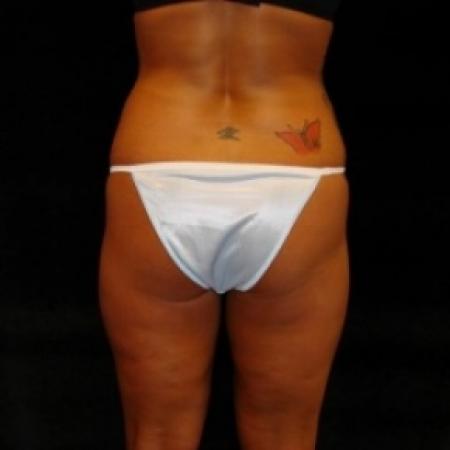 Before image 5 Case #80481 - Buttocks Augmentation Via Fat Grafting with Lipsuction of Abdomen, Waist, Flanks, and Outer Thighs