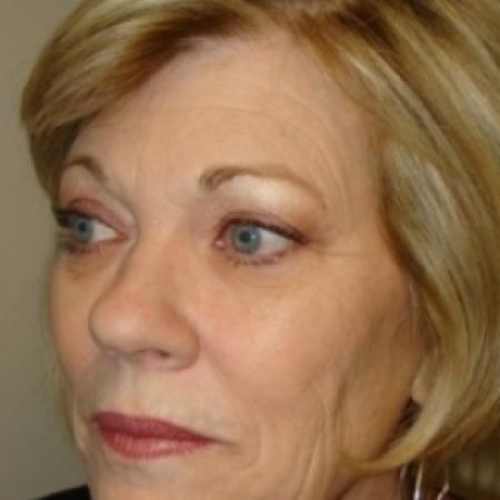 Before image 3 Case #79056 - Facelift