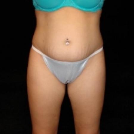 Before image 1 Case #80331 - Buttocks Augmentation Via Fat Grafting with Liposuction of Abdomen, Waist, Flanks, Dorsal Roll, Inner and Outer Thighs