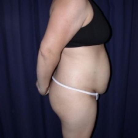 Before image 2 Case #79816 - Tmmy Tuck/ Lipo-Abdominoplasty