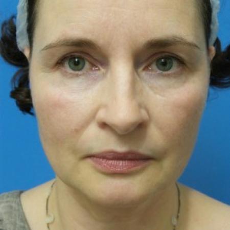 Before image 1 Case #86976 - 57 year old  -  Facelift/Submental Liposuction  -  2 months post-op
