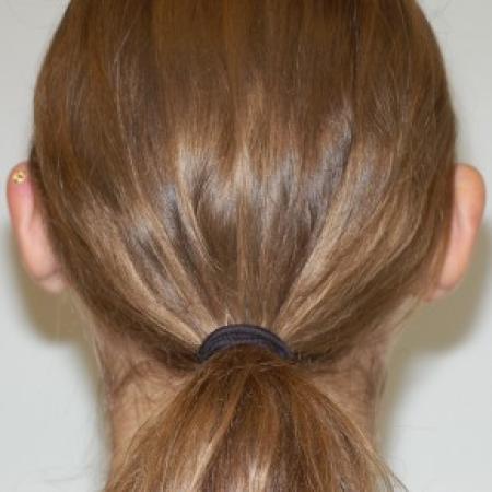 Before image 2 Case #86966 - Otoplasty (Ear Surgery)