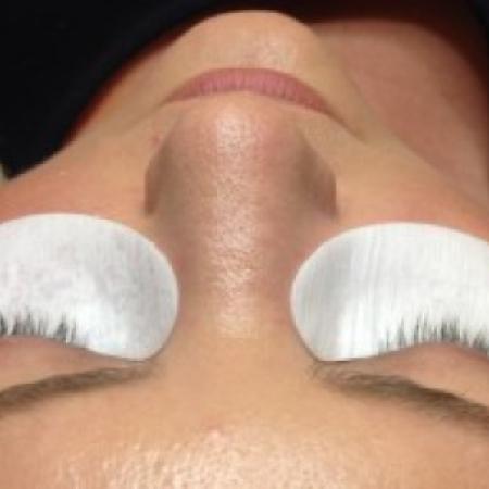 Before Case #86381 - 35 year old woman treated with eyelash enhancement