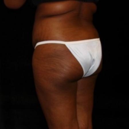 Before image 2 Case #80486 - Buttocks Augmentation Via Fat Grafting with Liposuction of Abdomen, Waist, Flanks, and Dorsal Roll