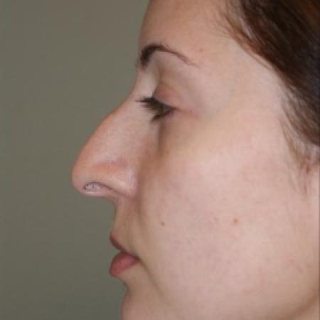 Before image 2 Case #81871 - Open Septorhinoplasty