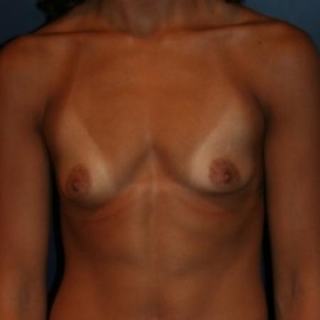 Before image 1 Case #80381 - Natural Proportional Breast Augmentation