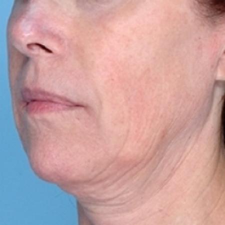 Before image 1 Case #79331 - Non-Surgical Focused Ultrasound