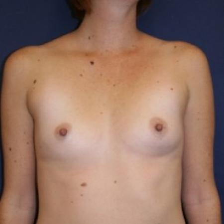 Before image 1 Case #81216 - Breast Augmentation