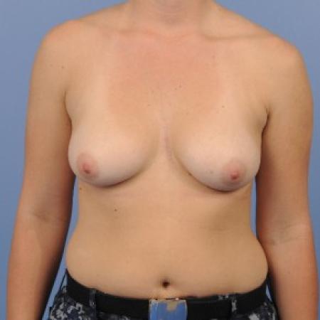 Before image 1 Case #87351 - Breast Augmentation in 27 year-old