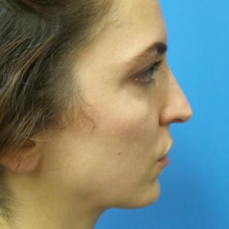 Before image 3 Case #87411 - 31 year-old  -  Open Rhinoplasty/Endoscopic Browlift  -  3 months post-op
