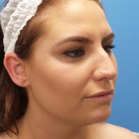 Before image 2 Case #87356 - 27 year-old  -  Rhinoplasty/Septoplasty/Turbinectomy/Liposuction to Neck  -  2 months post-op