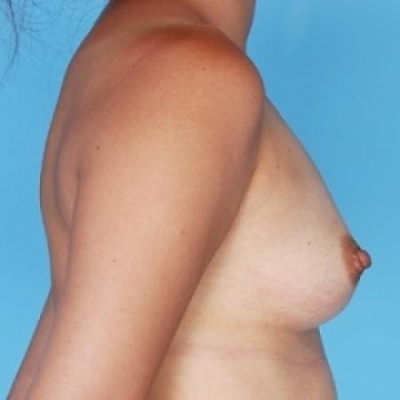 Before image 2 Case #79126 - Silicone 
