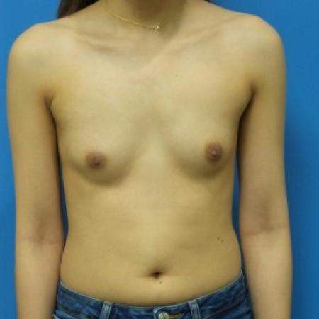Before image 1 Case #87936 - 25 year old - Submuscular - 255cc shaped silicone gel - 3 months post-op
