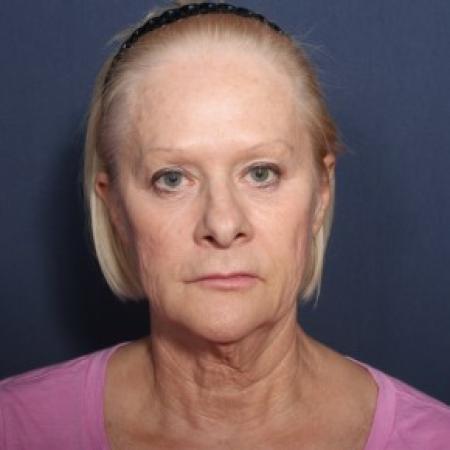 Before image 1 Case #84356 - 67 Years Old Female