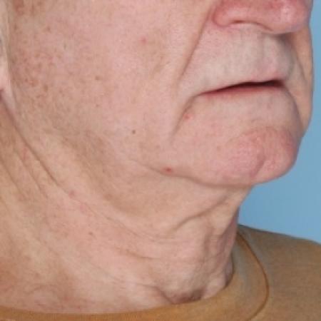 Before image 2 Case #80626 - Ulthera