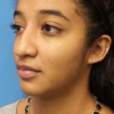 Before image 2 Case #86471 - Rhinoplasty/Septoplasty/Turbinectomy - 1 year post-op