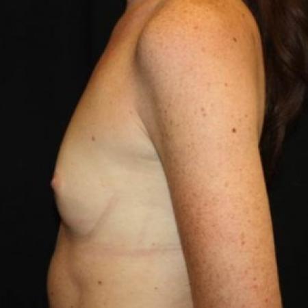 Before image 3 Case #85011 - Breast Augmentation - 26 year old female