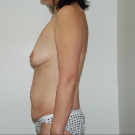 Before image 3 Case #83896 - Body Lift and Breast Augmentation