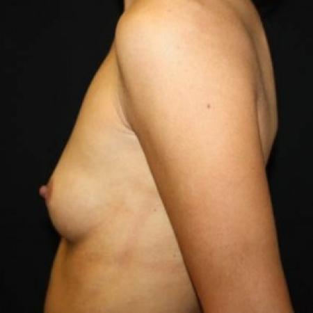 Before image 3 Case #85306 - Breast Augmentation - 27 year old female