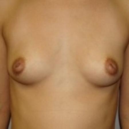 Before image 1 Case #79391 - Breast Augmentation