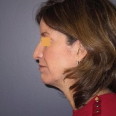 Before image 3 Case #81151 - Rhinoplasty