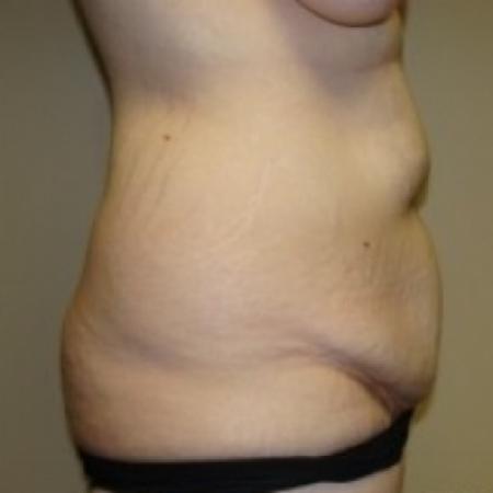 Before image 3 Case #79486 - Tummy Tuck