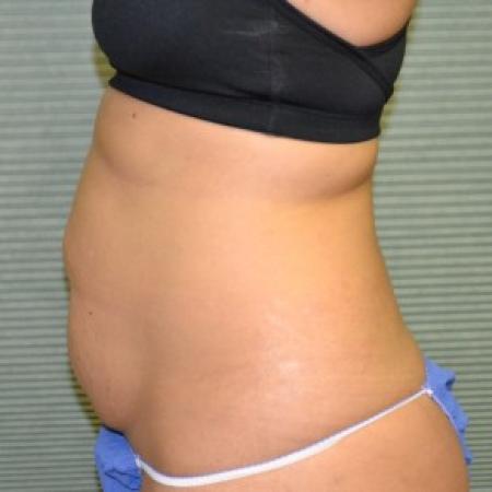 Before image 3 Case #87886 - Tummy Tuck