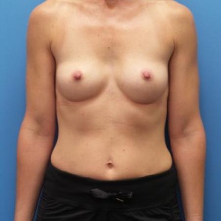 Before image 1 Case #86426 - Submuscular Breast Augmentation Right Side: 330cc, Left Side: 295cc Moderate Plus Projection Silicone Gel Implants