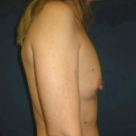 Before image 3 Case #82886 - Breast Augmentation using Memory Shape Gel Implants