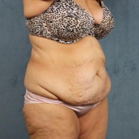 Before image 2 Case #82551 - extended abdominoplasty (tummy tuck) after massive weight loss