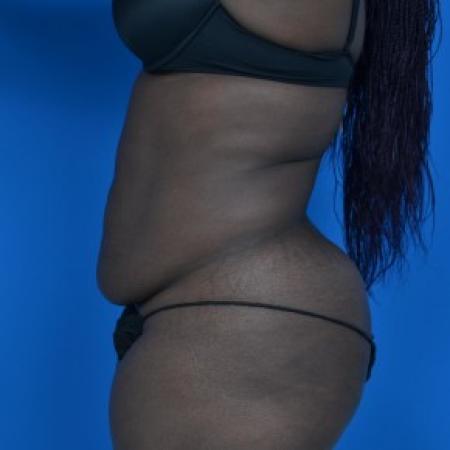 Before image 3 Case #87871 - Tummy Tuck