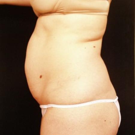 Before image 3 Case #81726 - Tummy Tuck