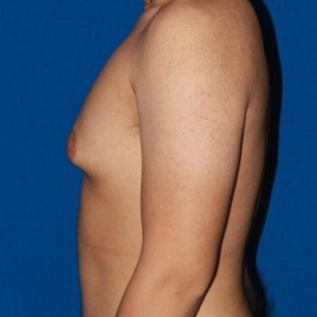 Before image 3 Case #79991 - Gynecomastia male breast reduction