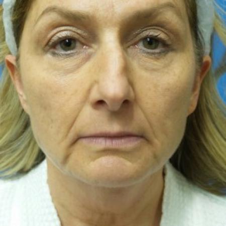 Before image 1 Case #87171 - 55 year old  -  Facelift  -   3 month post-op