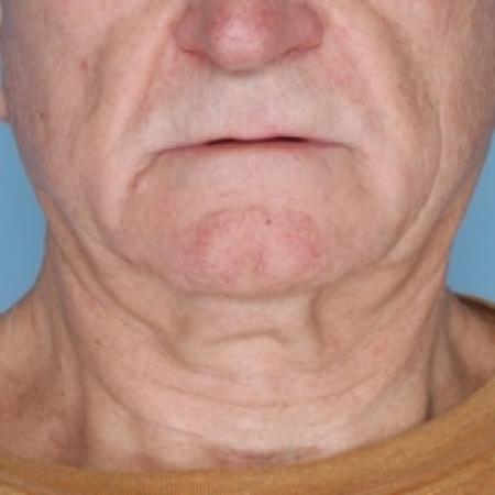 Before image 1 Case #80626 - Ulthera