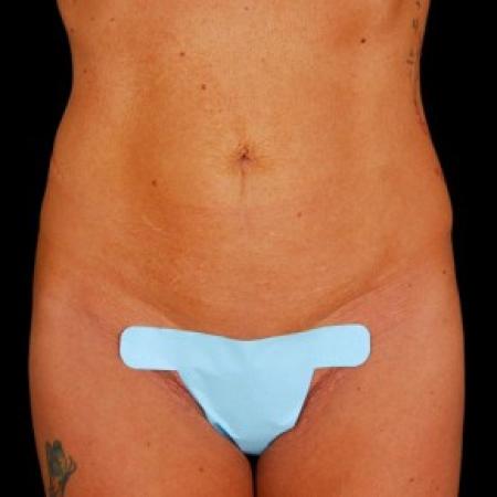 Before image 1 Case #81571 - Tummy Tuck