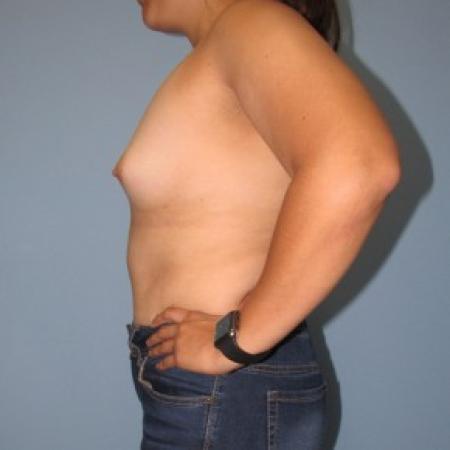 Before image 2 Case #87201 - Breast Augmentation in 25 year-old
