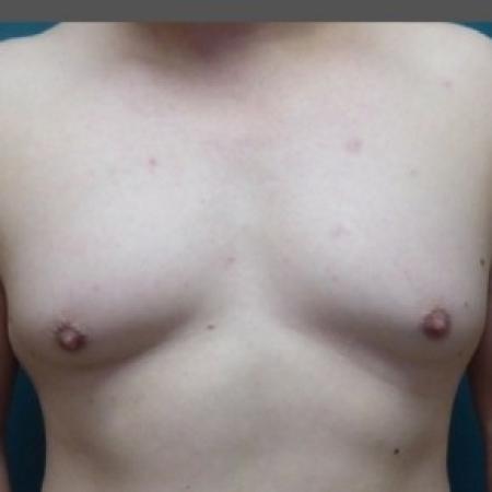 Before image 1 Case #86676 - Gynecomastia Correction