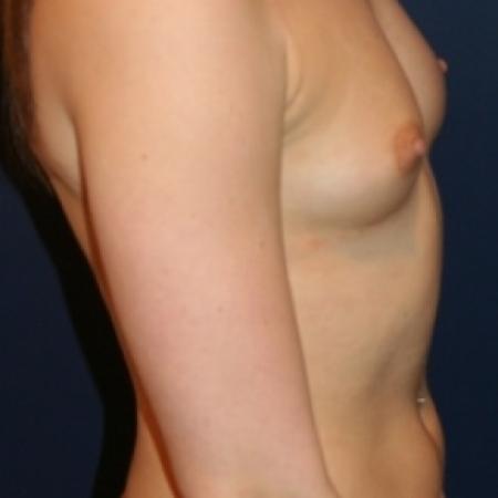 Before image 3 Case #79751 - Proportional Breast Augmentation