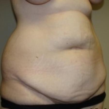 Before image 2 Case #79486 - Tummy Tuck